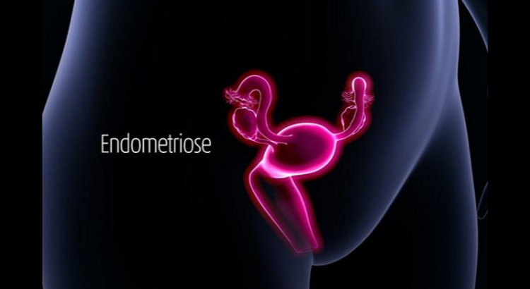 Endométrio na parte interna do útero e a palavra endometriose destacada